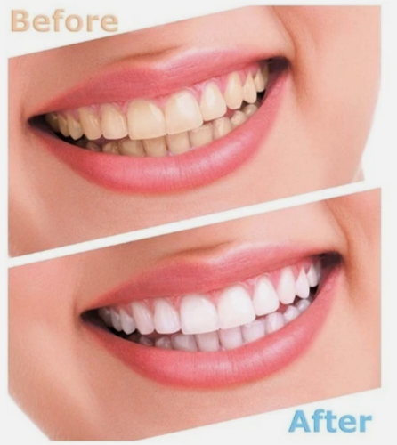 5D Advanced Teeth Whitening Strips (14 Strips) 7 Upper 7 Lower Hydrogen Peroxide